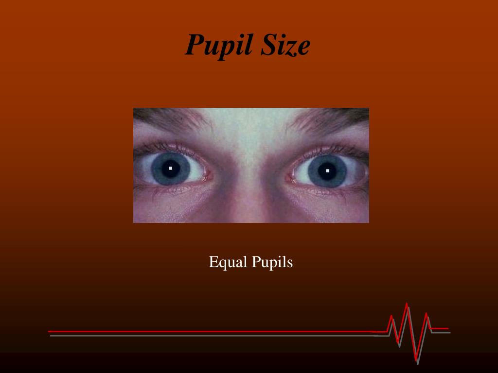 unequal pupil size in child