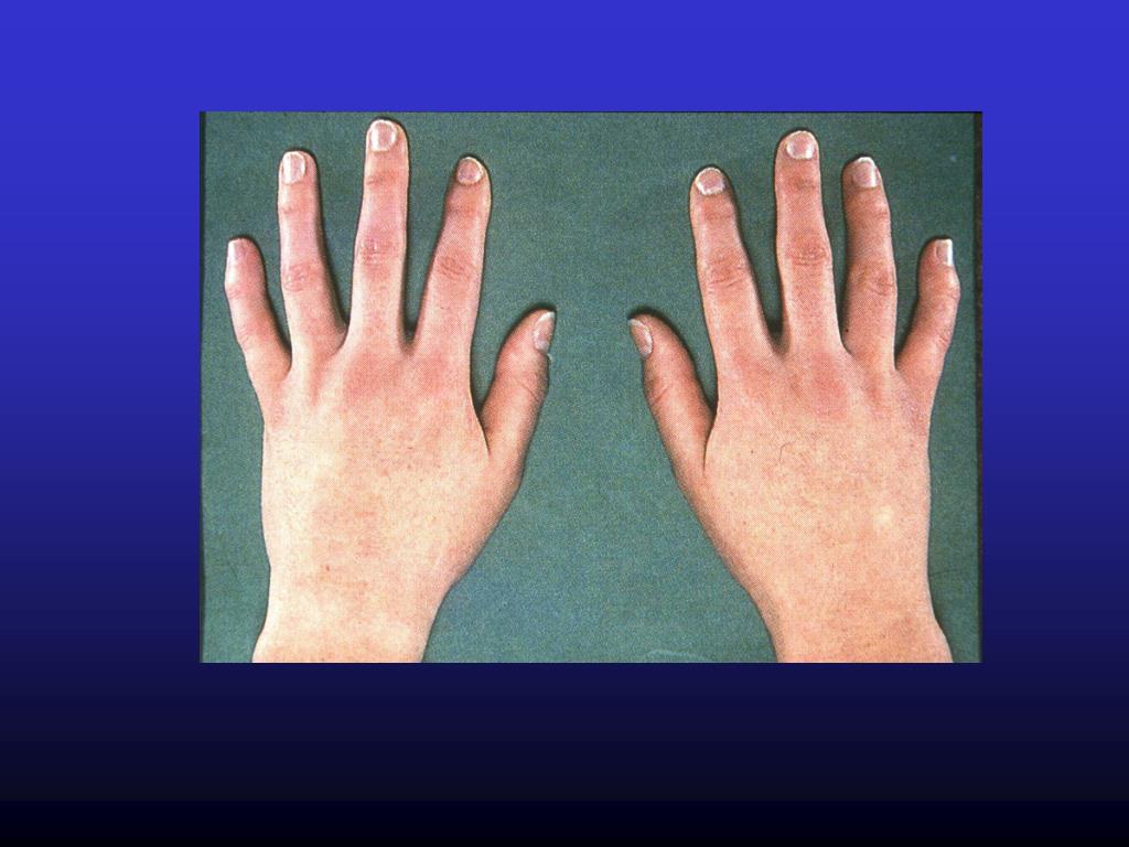 rheumatoid arthritis 2. szakasz)