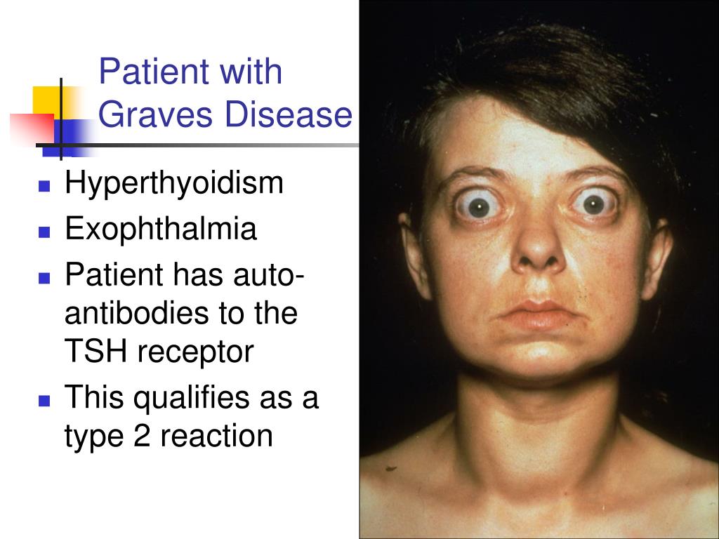 Graves Disease Homeopathic Medicine at Ann Broman blog
