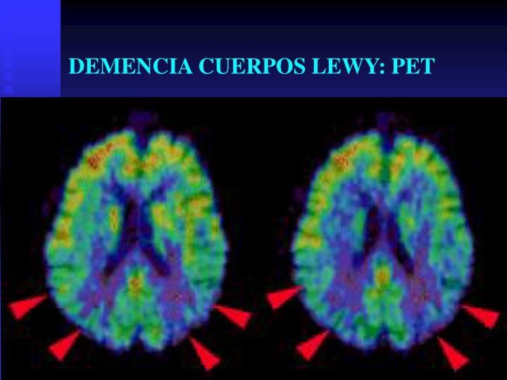 Ppt Demencia Por Cuerpos De Lewy Powerpoint Presentation Id540556 8634