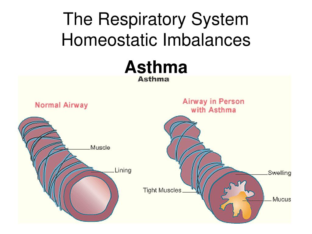Сайт астм. Бронхиальная астма. Бронхи в норме и при астме. Бронхиальная астма бронхи в норме.