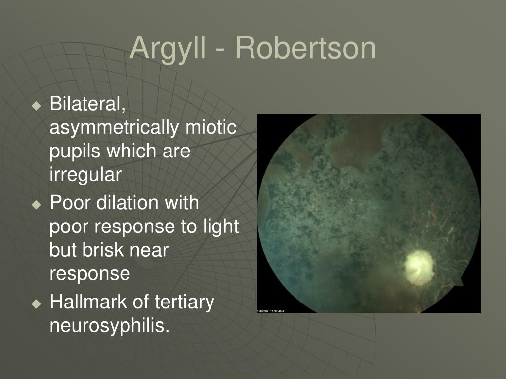 argyll robertson pupil afferent or efferent limb loss argyll robertson pupil afferent or efferent limb loss