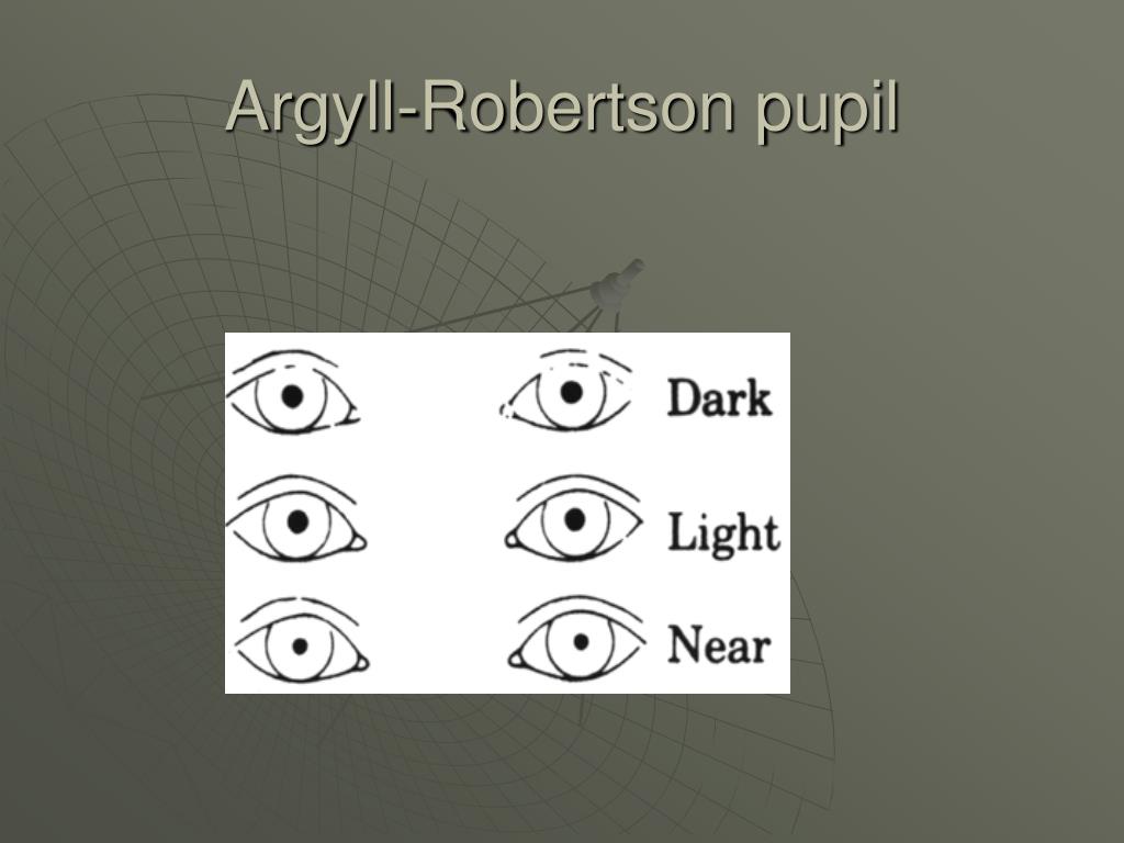 argyll robertson pupil symptoms argyll robertson pupil symptoms