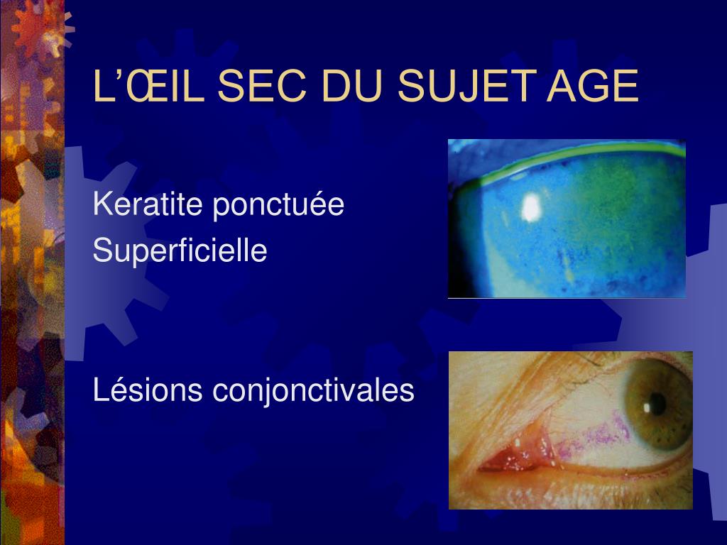 PPT L’ŒIL ROUGE ET IRRITE DU SUJET AGE PowerPoint Presentation, free — free download