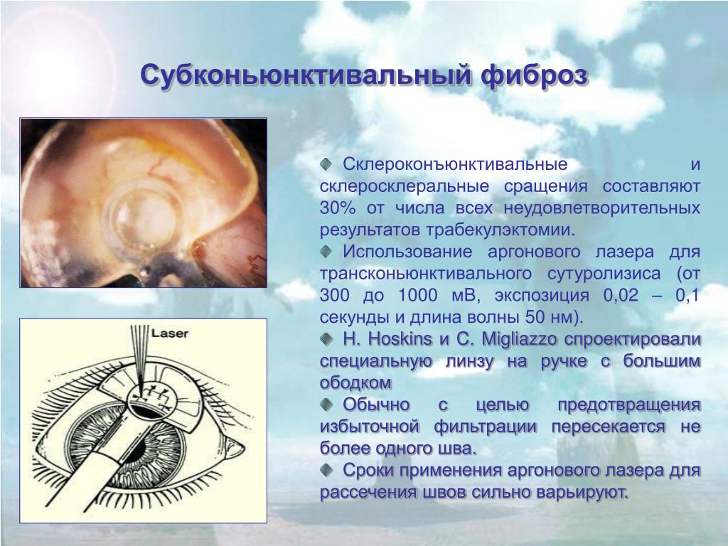Фиброз после лечения. Трабекулэктомия при глаукоме презентация. Лазерные методы лечения глаукомы. Эписклеральный фиброз. Фиброз глаза операция лазером.
