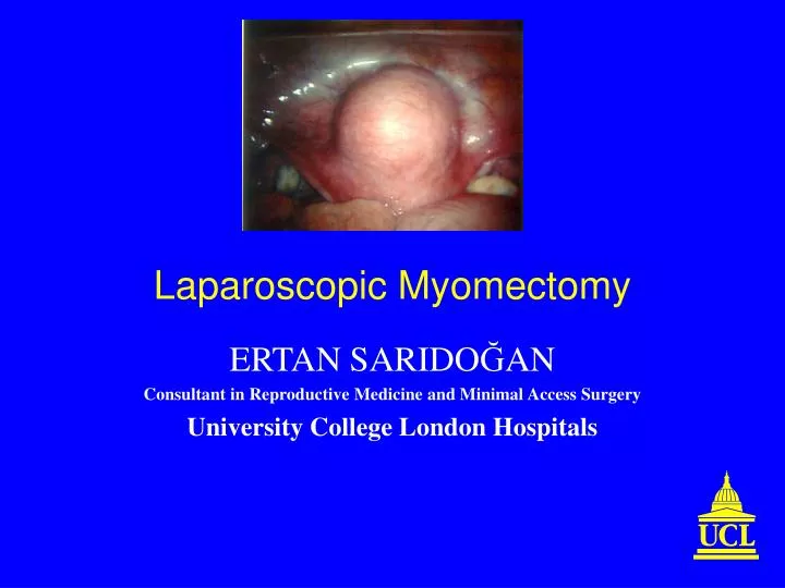 laparoscopic myomectomy n.