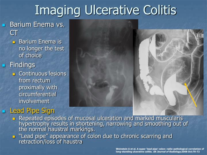 PPT - Review of Inflammatory Bowel Disease PowerPoint Presentation - ID ...