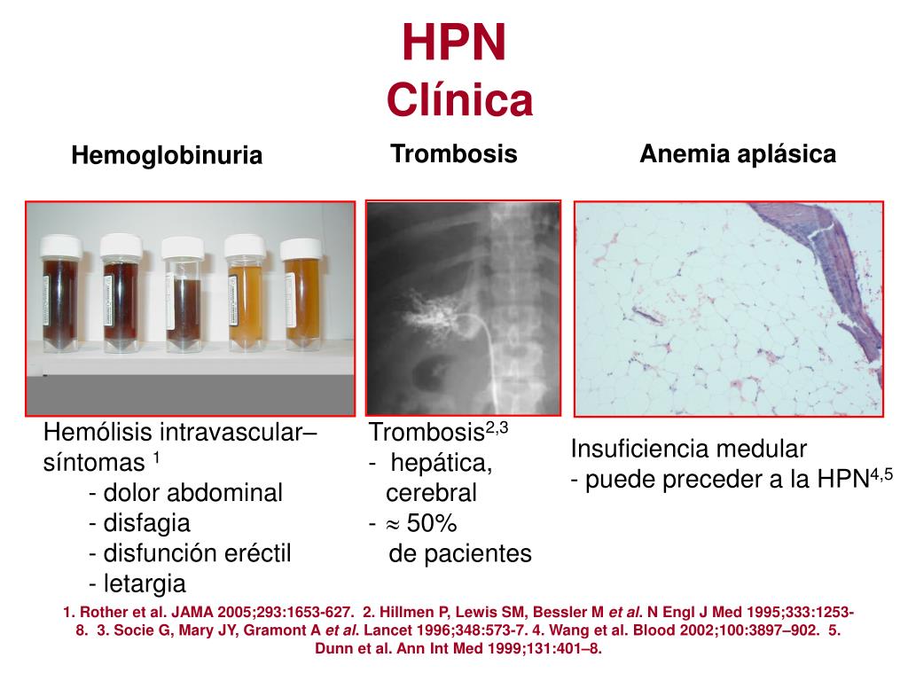 disfunción eréctil nocturna paroxística hemoglobinuria