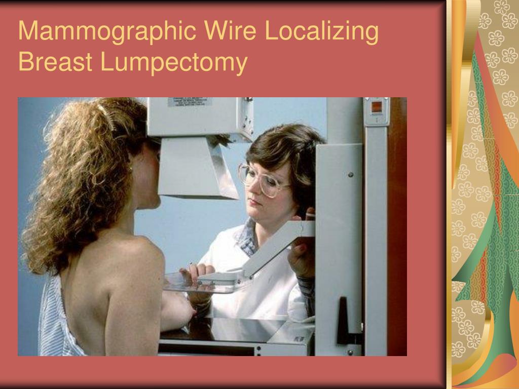 PPT BREAST CANCER UPDATE DETECTION TO DIAGNOSIS PowerPoint