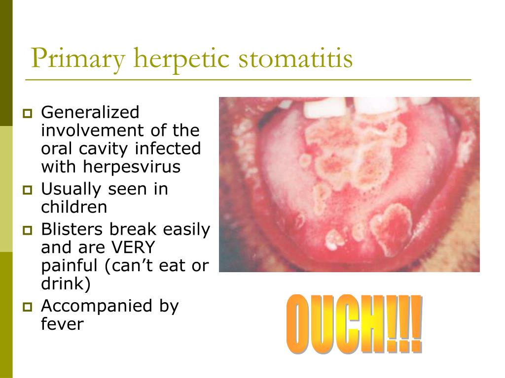 Herpetic Stomatitis Pictures