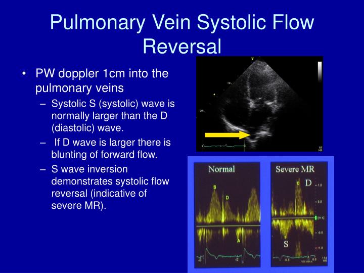 PPT - How to Diagnose and Assess Severity of Mitral Regurgitation by ...