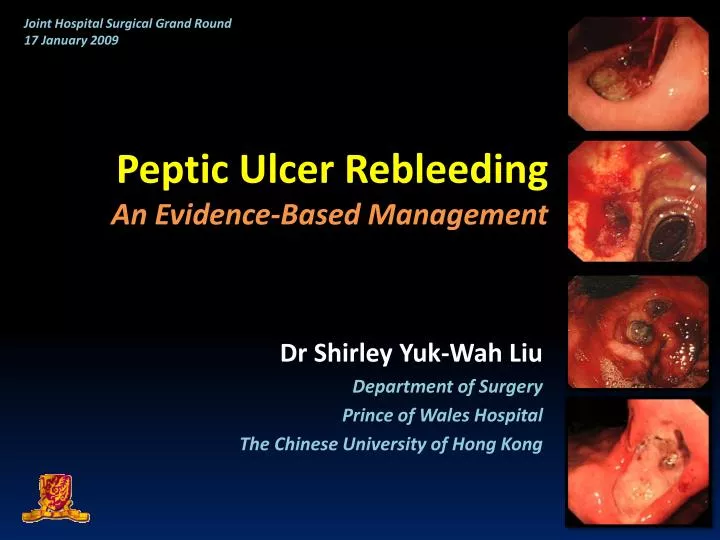 peptic ulcer rebleeding an evidence based management n.