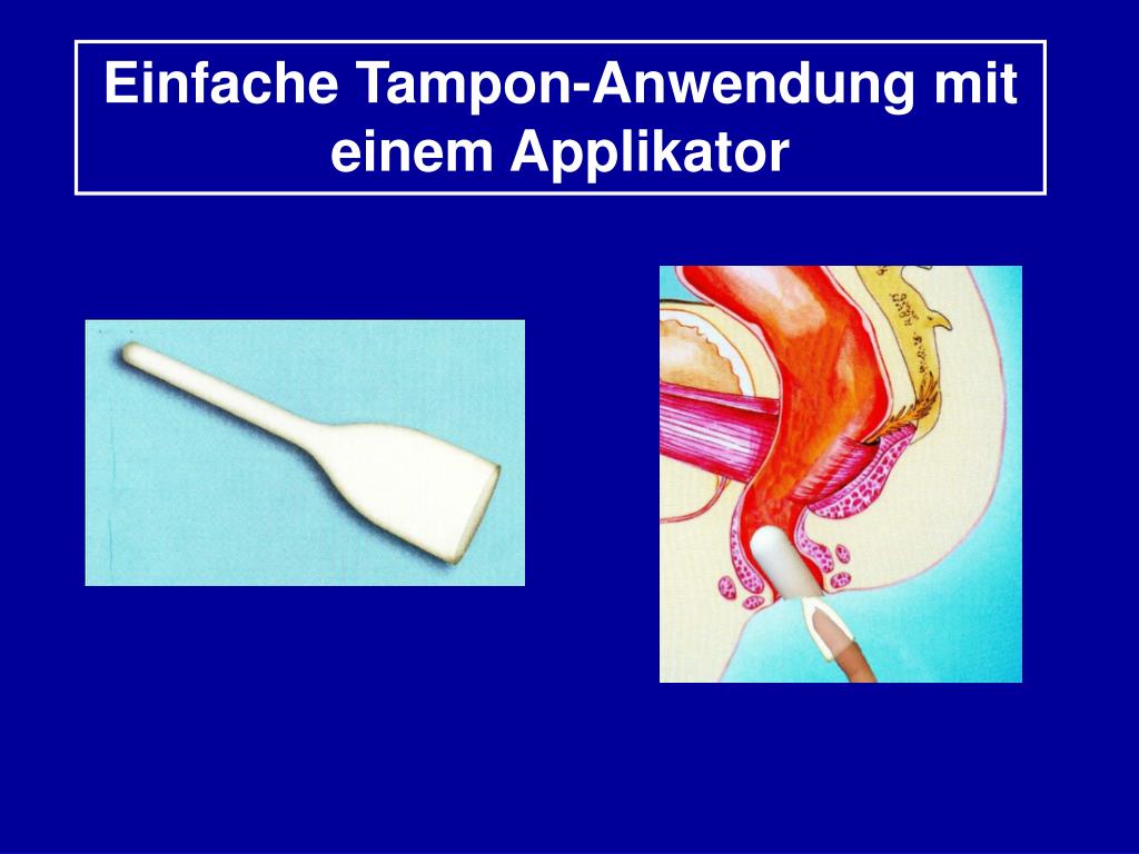 PPT - HYGIENE-TAMPONS für den Darm – ein neuer Weg in der Behandlung der  Inkontinenz PowerPoint Presentation - ID:598400