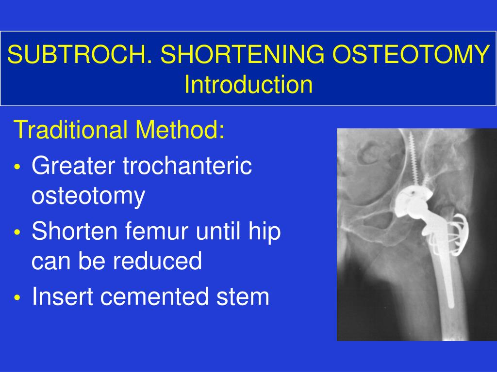 Ppt Shortening Subtrochanteric Osteotomy For High Hip Dislocation