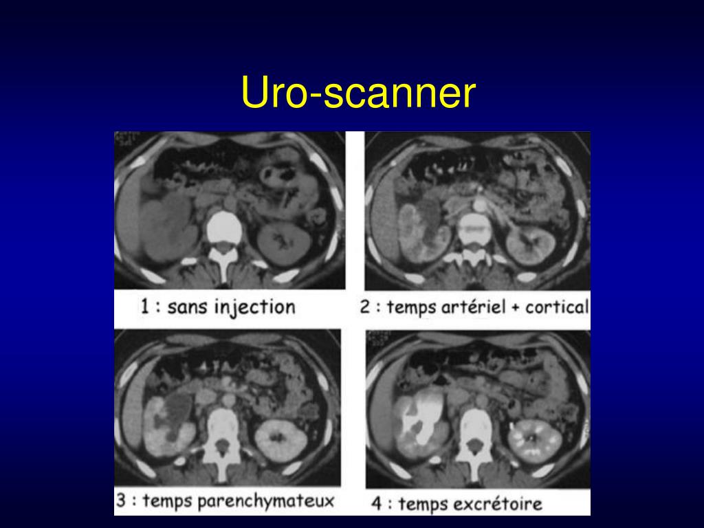PPT H maturie D origine Urologique PowerPoint Presentation Free 
