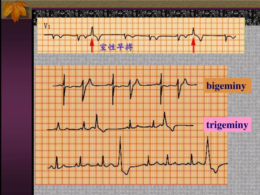 PPT Part IV Arrhythmia PowerPoint Presentation Free Download ID 613051
