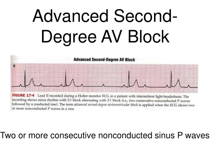 PPT - Atrioventricular (AV) Heart Block PowerPoint Presentation - ID:613537