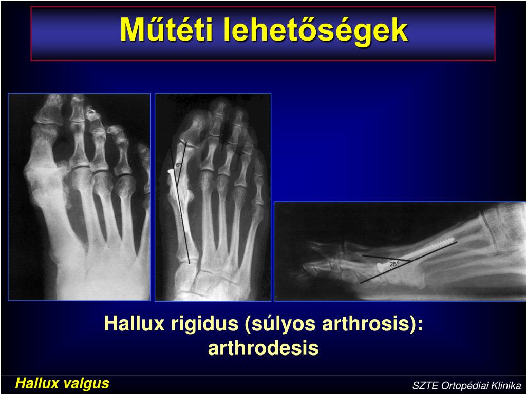 súlyos arthrosis