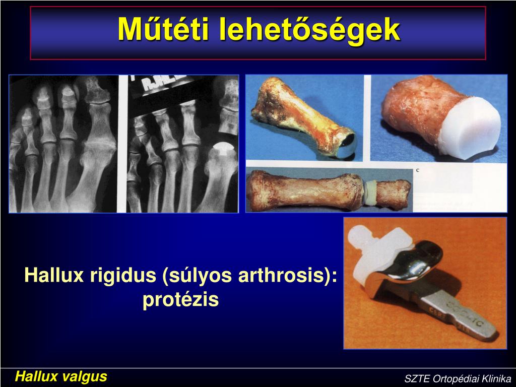 Arthrosis és fájdalom | dr. Sütő Gábor