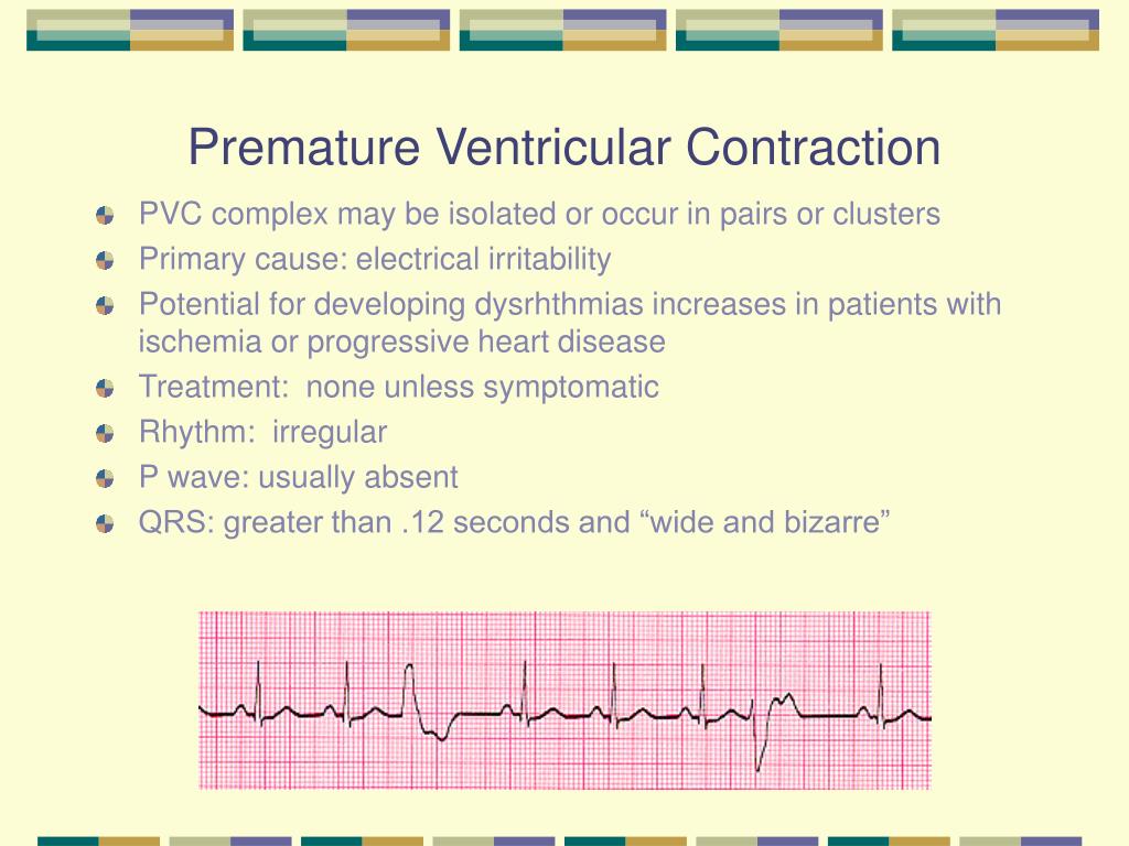 Premature Ventricular Contractions Pvcs Example Images And Photos My ...