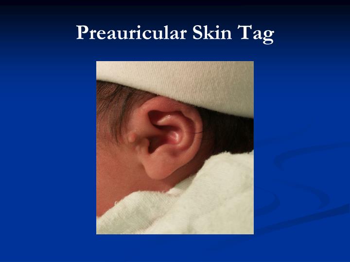Skin Tag In Ear PPT - Common Newborn Findings PowerPoint Presentation - ID:625692