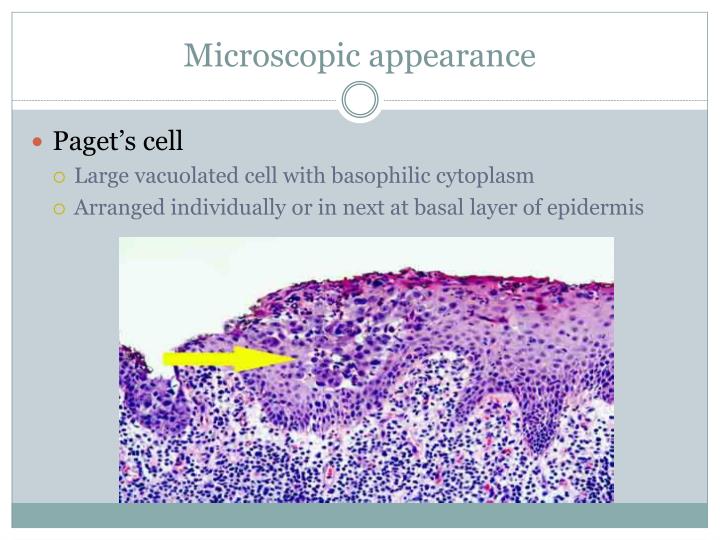 PPT Perianal Paget’s disease PowerPoint Presentation ID629754