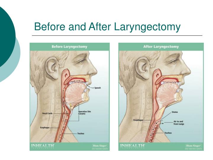 PPT - TRACHEOESOPHAGEAL PUNCTURE VOICE PROSTHESIS (TEP VP) AND SPEAKING ...