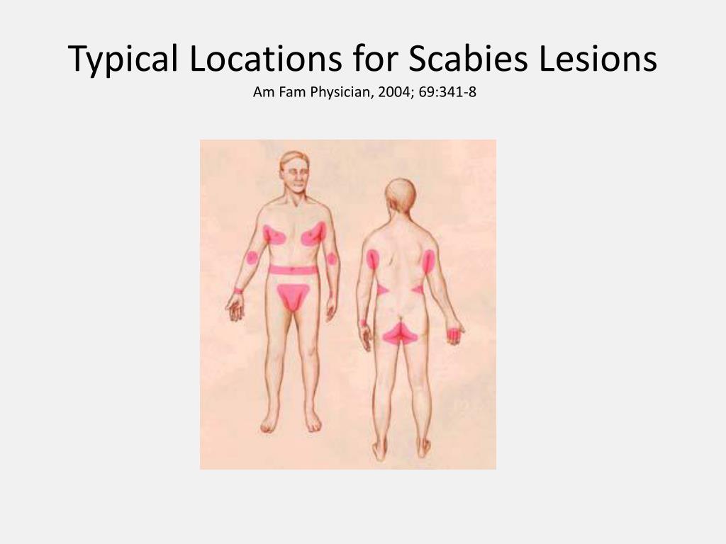 Ppt Headlice And Scabies Powerpoint Presentation Free Download Id