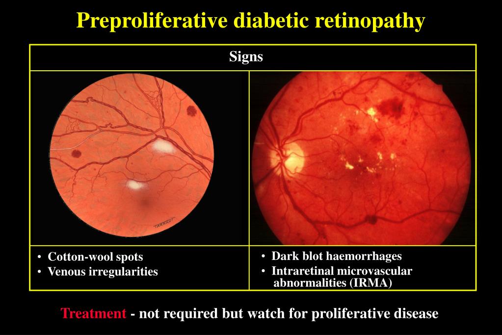 case presentation of diabetic retinopathy