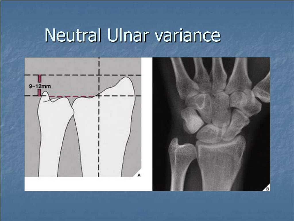 PPT Distal Forearm Fractures And Dislocations PowerPoint Presentation 