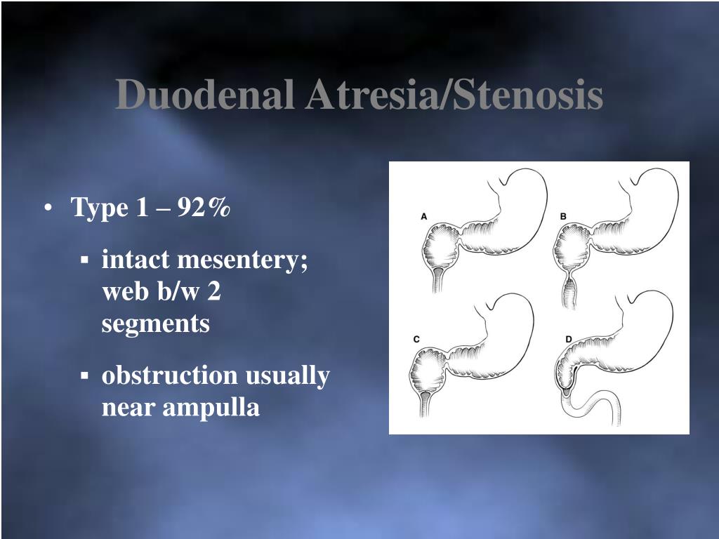 duodenal atresia อาการ pictures
