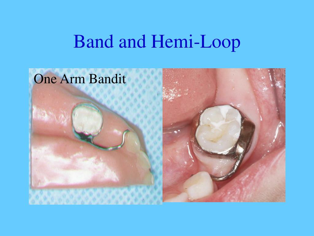 Band And Loop Space Maintainer Code Get Images