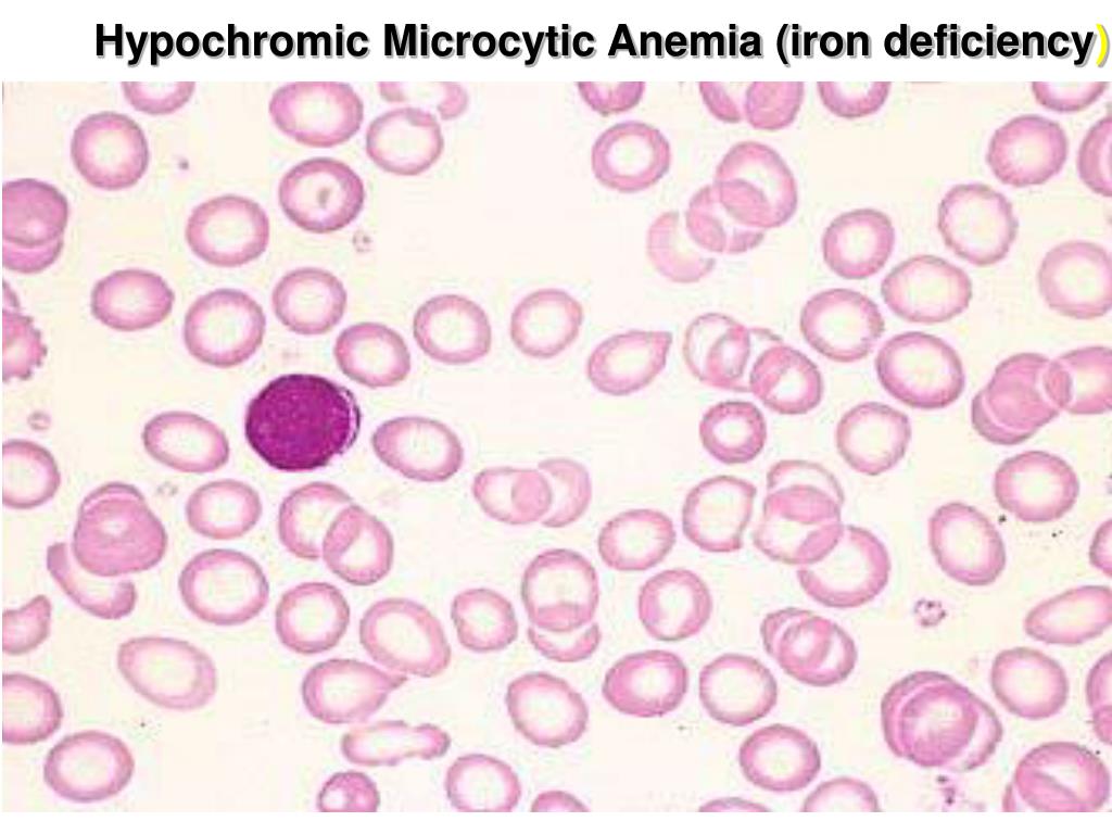 Гипохромия железодефицитная анемия. Гипохромная анемия мазок крови. Гипохромная микроцитарная анемия. Гипохромная анемия картина крови. Микроцитарная анемия мазок крови.