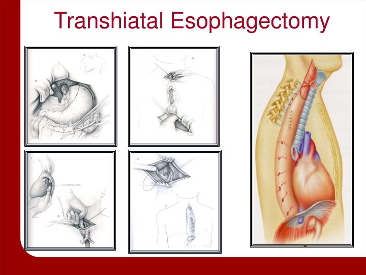 PPT - Surgical Intervention for Esophageal Cancer PowerPoint ...