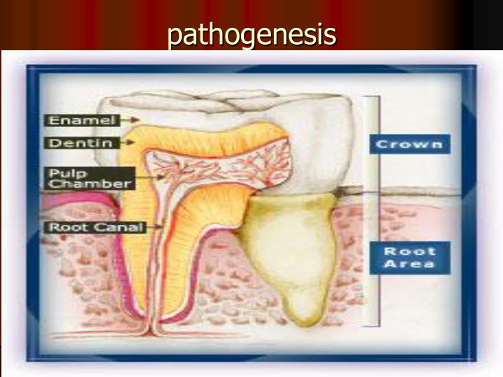 PPT - PULPITIS Inflammation of dental pulp Main source for dental pain  Causes Dental caries- the most common cause Traumati PowerPoint  Presentation - ID:657456