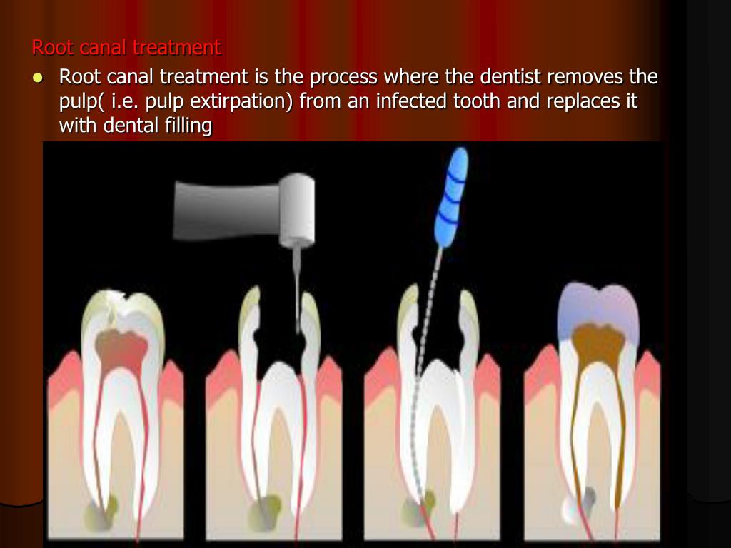 pulp dental treatment inflammation canal pulpitis root tooth pain ppt caries causes source cause common dead powerpoint presentation extraction removal