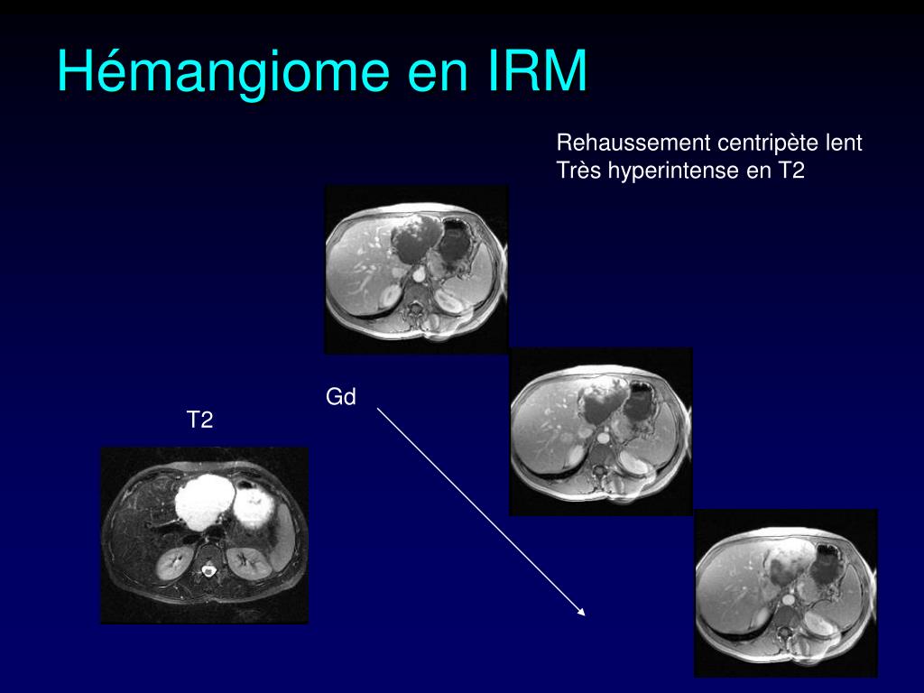 PPT - Diagnostic des tumeurs du foie PowerPoint Presentation, free download  - ID:658466