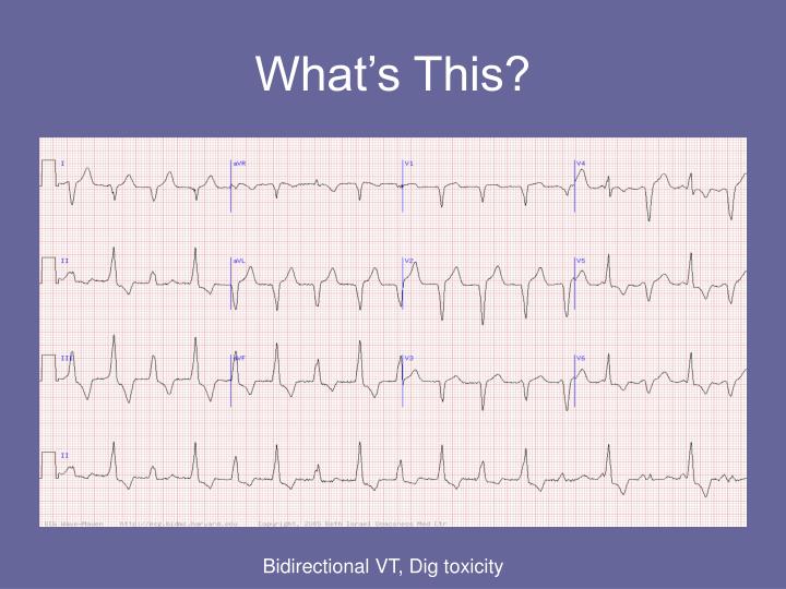 PPT - Some Interesting EKGs PowerPoint Presentation - ID:661112