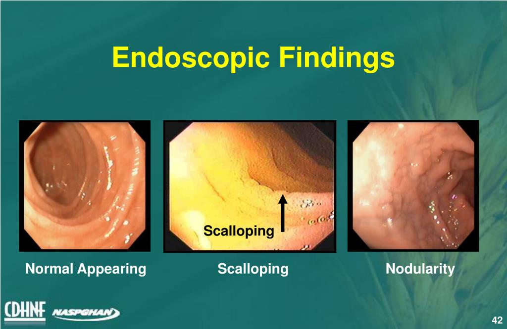ibs endoscopy findings ibs endoscopy findings