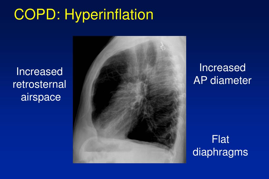 PPT Chronic Obstructive Pulmonary Disease And Asthma Update 