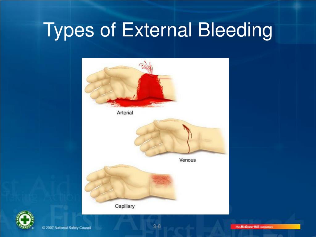 PPT - Controlling Bleeding PowerPoint Presentation - ID:669107