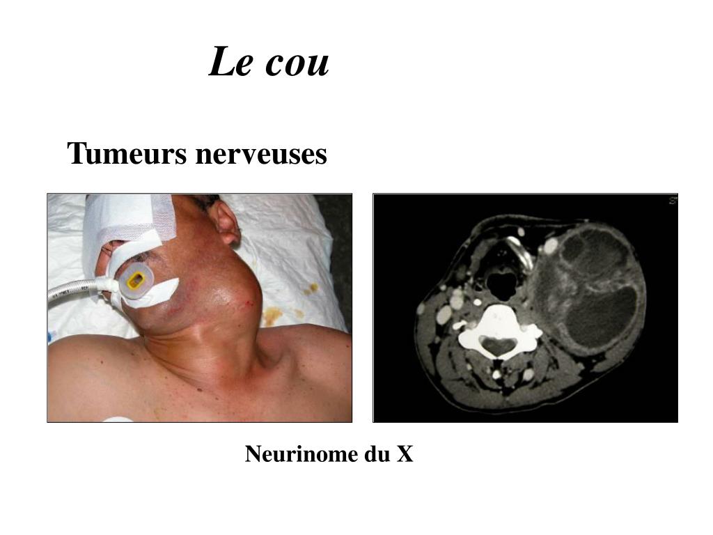 PPT - Tumeurs cervicales Présentation réalisée à l’EPU ORL de la clinique chirurgicale du golfe ...