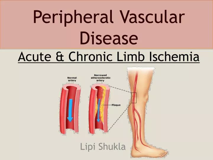 PPT - Peripheral Vascular Disease Acute & Chronic Limb ...