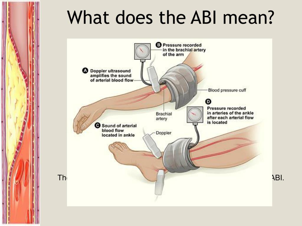 PPT - Peripheral Vascular Disease Acute & Chronic Limb Ischemia