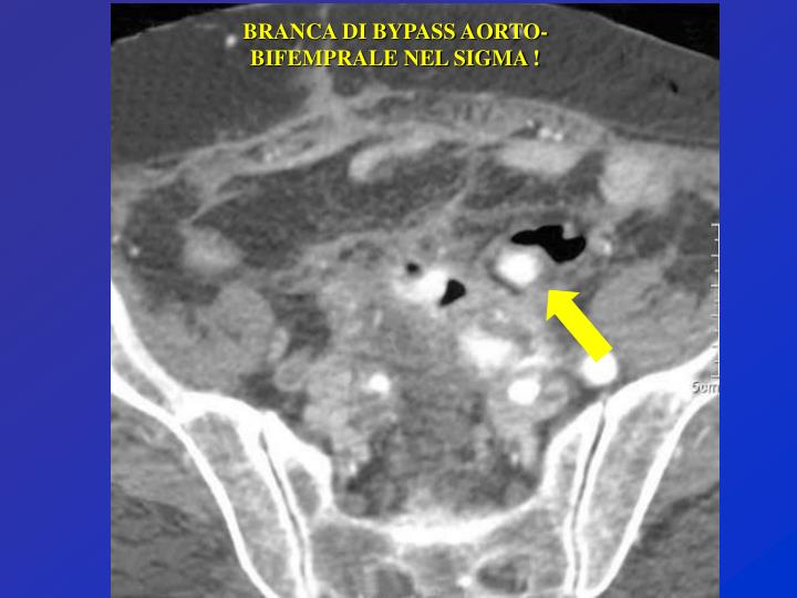 Ispessimento Pareti Del Sigma Cause