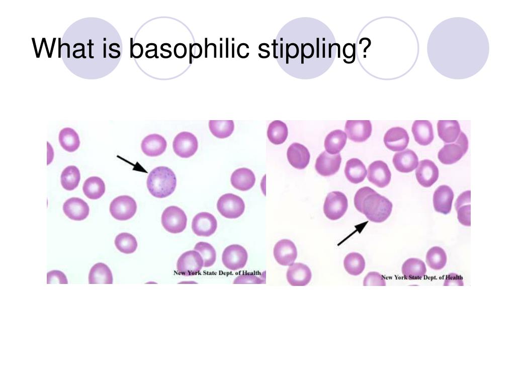 Basophilic Stippling Thalassemia