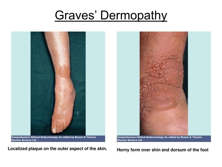 PPT Thyroid Disease Facts PowerPoint Presentation ID 67801