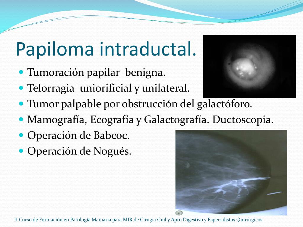 papiloma intraductal durante el embarazo detox md pembroke pines