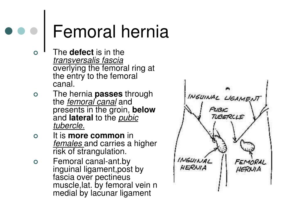 Femoral Hernia Images