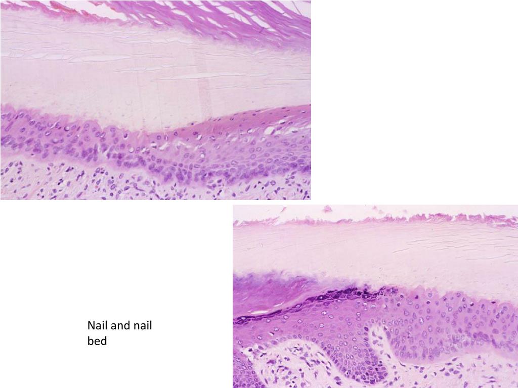 Onychomatricoma with dorsal pterygium: Pathogenic mechanisms in 3 cases